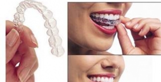 Invisalign - Kỹ thuật chỉnh nha thế hệ mới không mắc cài