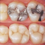 Trám Amalgam
