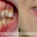 Cải thiện nụ cười với răng nhiễm tertracyclin với Mặt dán sứ