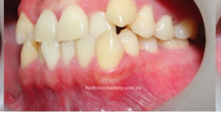 Chỉnh hình răng thẩm mỹ điều trị răng chen chúc - cắn chéo với mắc cài kim loại