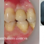 Cấy ghép răng implant 6