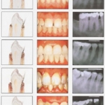 Các yếu tố phụ gây nha chu viêm: 