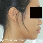 Chỉnh hình răng thẩm mỹ điều trị răng hô với mắc cài  kim loại