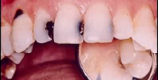 Với vi khuẩn: Có thể chủng ngừa để diệt con streptococcus mutans hay không? 
