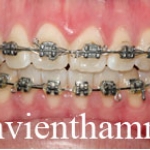 Chỉnh hình răng thẩm mỹ điều trị răng chen chúc với mắc cài kim loại 3