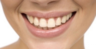 NHỮNG ĐIỀU CẦN BIẾT TRƯỚC KHI TẨY TRẮNG RĂNG: 