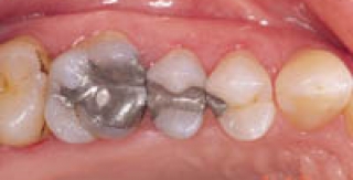 Hợp chất trám răng chứa thủy ngân an toàn cho sức khỏe