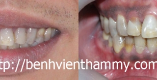 Răng sứ Emax Zircad - Ivoclar Vivadent - Thụy Sỹ 24