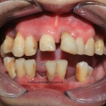 Phục hình lắp liền sau phẫu thuật và nhổ răng !