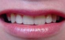 Răng nanh ngầm - Có nên nhổ bỏ?