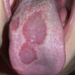 Viêm lưỡi bản đồ 