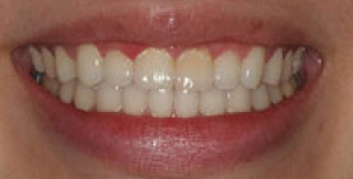 Giảm cân, giảm luôn bệnh nướu