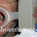 Phục hình răng thẩm mỹ răng nhiễm tertracyclin với Răng sứ Emax Ivoclar vivadent