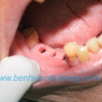 Phục hình trên Implant