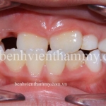 Chỉnh hình răng mọc lệch, thưa sớm cho trẻ