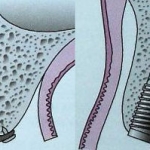 Tại sao cần phải ghép xương, ghép nướu? 