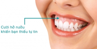 CƯỜI HỞ NƯỚU DO RĂNG CỬA HÀM TRÊN NGẮN