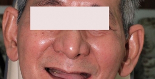 Nụ cười mới với Implant toàn hàm