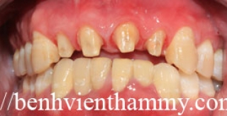 Răng sứ Emax Zircad - Ivoclar Vivadent - Thụy Sỹ 20
