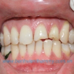 Răng sứ Emax Zircad - Ivoclar Vivadent 2