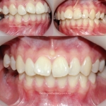 Niềng răng không nhổ răng