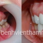 Răng sứ thẩm mỹ cải thiện nụ cười với răng nhiễm tertracyclin