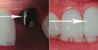SƠ LƯỢC VỀ VIỆC CẤY GHÉP XƯƠNG TRONG PHẪU THUẬT IMPLANT