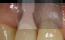 LỊCH SỬ PHÁT TRIỂN IMPLANT TỨC THÌ