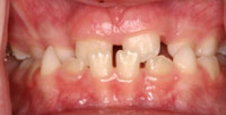 Vẩu xương hàm dưới và cách điều trị