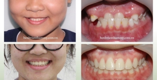 Niềng răng móm (khớp cắn ngược) ở trẻ em và người lớn