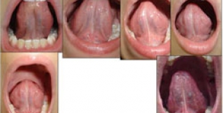 Dính thắng lưỡi ở trẻ em - những điều cần biết - Phần 1