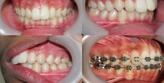 Chỉnh hình răng thẩm mỹ điều trị răng cắn chìa hô với mắc cài kim loại