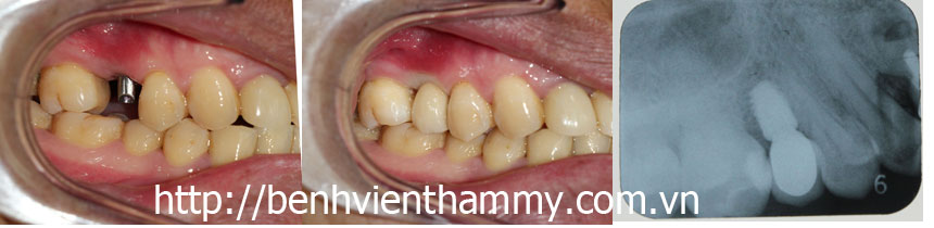 cay-ghep-rang-implant005