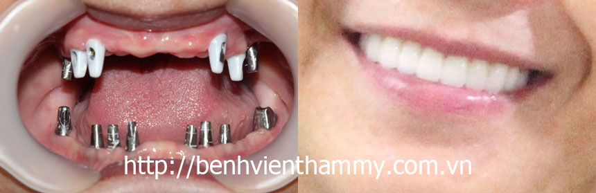 cay ghep rang implant 07 cay ghep rang implant 07