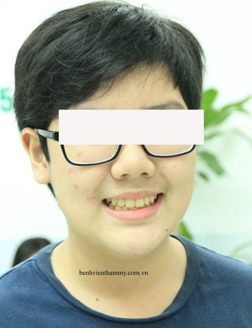 nieng rang chen chuc khong nho rang 2e