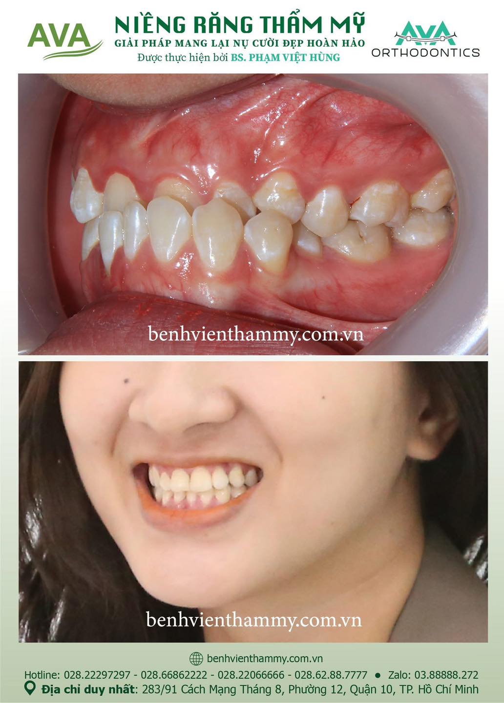 hinh anh nieng rang mom khop can nguoc 3