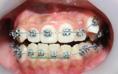 chinh-hinh-ava-3