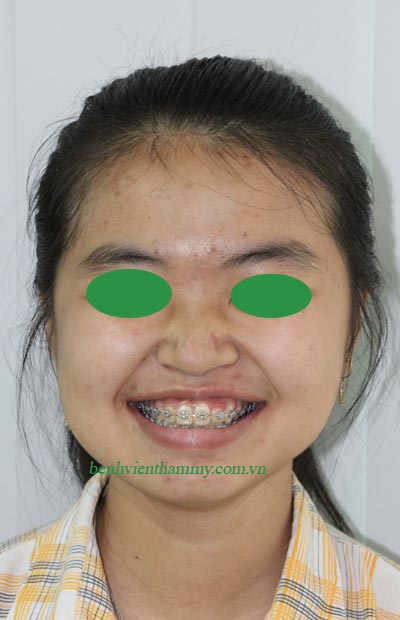 chinh-hinh-ava-7