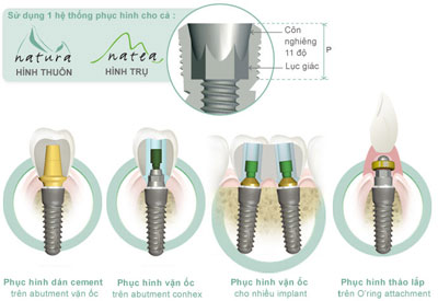 prothese-natura-ava
