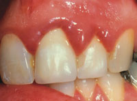 viem-nuou-rang-gingivitis