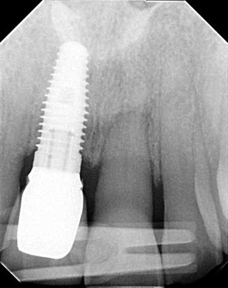 Implant