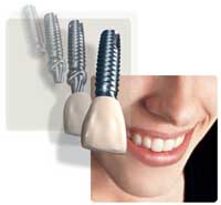 dental-implants