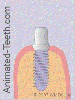 dental-implants